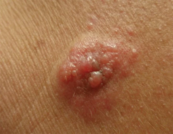 AMELANOTIC MELANOMA