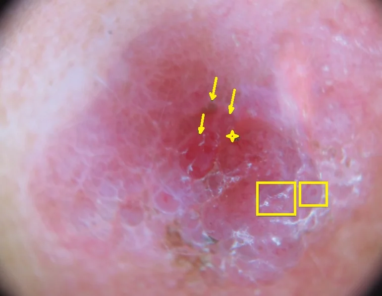 AMELANOTIC MELANOMA