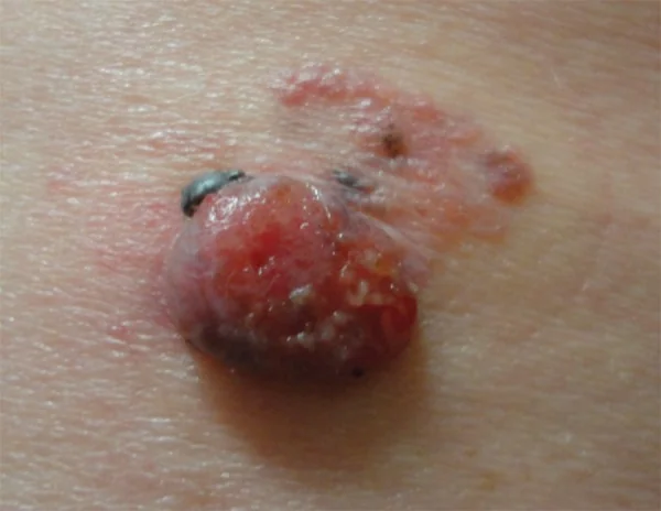 AMELANOTIC MELANOMA