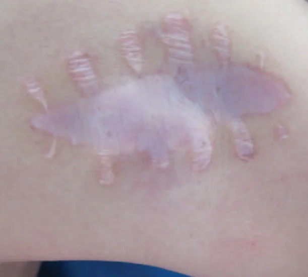 AMELANOTIC MELANOMA