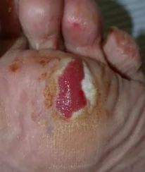 AMELANOTIC MELANOMA - FOOT