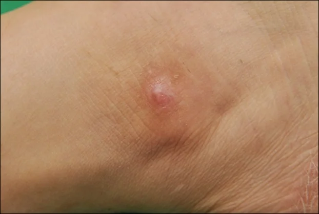 AMELANOTIC MELANOMA