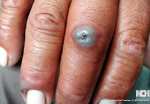 CUTANEOUS ANTHRAX
