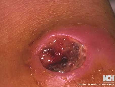 CUTANEOUS ANTHRAX