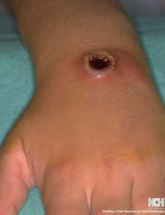 CUTANEOUS ANTHRAX