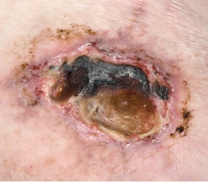 ANTIPHOSPHOLIPID SYNDROME - CUTANEOUS ULCER 