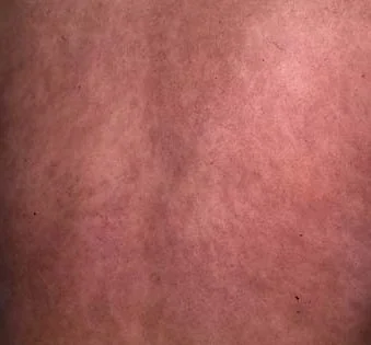 ASHY DERMATOSIS