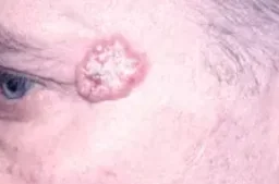 BASAL CELL CARCINOMA