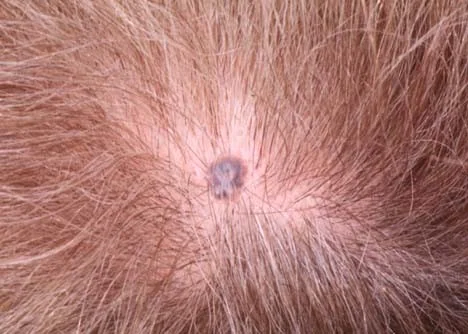 BASAL CELL CARCINOMA