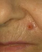 BASAL CELL CARCINOMA