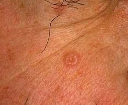 BASAL CELL CARCINOMA