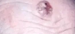 BASAL CELL CARCINOMA 