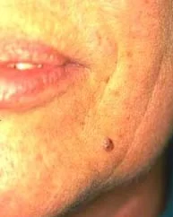 BASAL CELL CARCINOMA