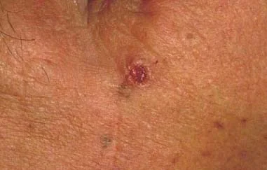 BASAL CELL CARCINOMA