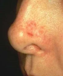 BASAL CELL CARCINOMA