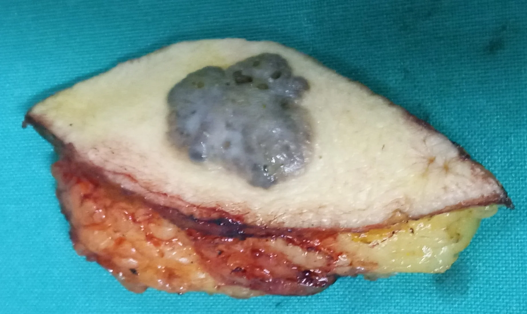 BASAL CELL CARCINOMA