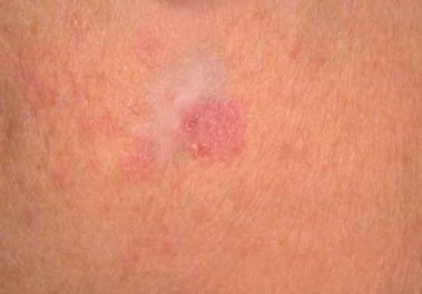 BASAL CELL CARCINOMA
