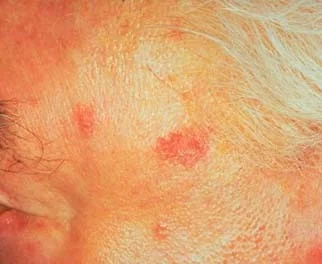 BASAL CELL CARCINOMA