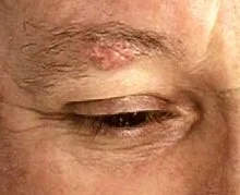 BASAL CELL CARCINOMA