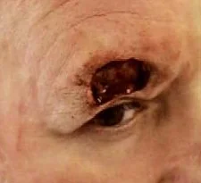 BASAL CELL CARCINOMA