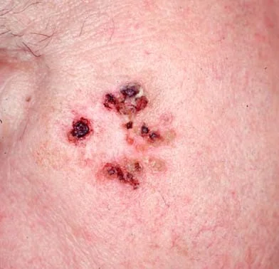 BASAL CELL CARCINOMA