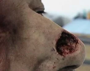 BASAL CELL CARCINOMA