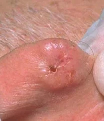 BASAL CELL CARCINOMA