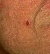 BASAL CELL CARCINOMA