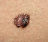 BASAL CELL NEVUS SYNDROME