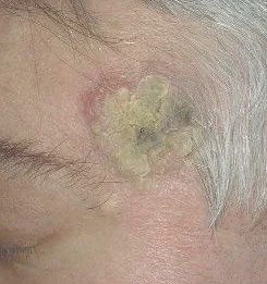 BASOSQUAMOUS CARCINOMA