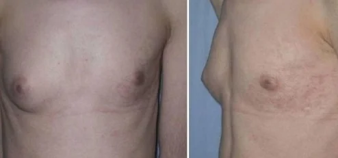 BECKER'S NEVOUS SYNDROME + BREAST HYPOPLASIA