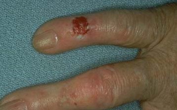 BOWEN'S DISEASE