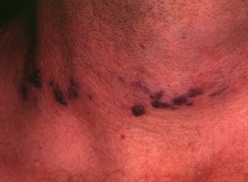 CAVERNOUS HEMANGIOMA 