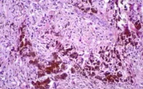 CELLULAR BLUE NEVUS
