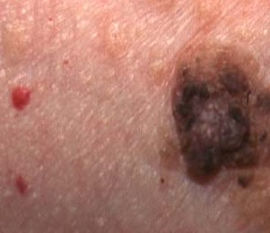 SEBORRHEIC KARATOSIS