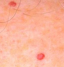 CHERRY ANGIOMA