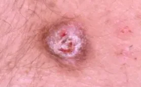 COMMON WART