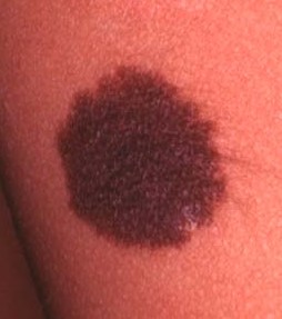 CONGENITAL NEVUS