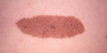 CONGENITAL NEVUS