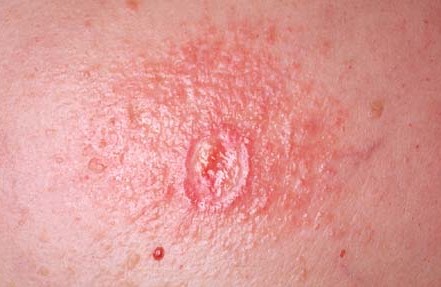 CONTACT DERMATITIS