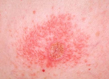 CONTACT DERMATITIS
