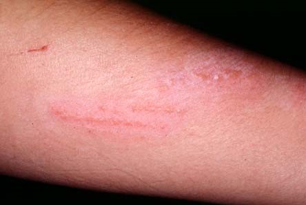 CONTACT DERMATITIS