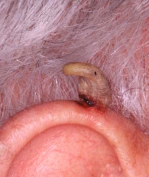 CUTANEOUS HORN 
