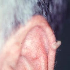CUTANEOUS HORN
