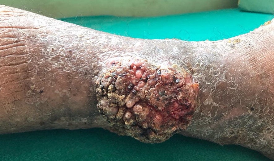 CUTANEOUS ACTINOMYCOSIS
