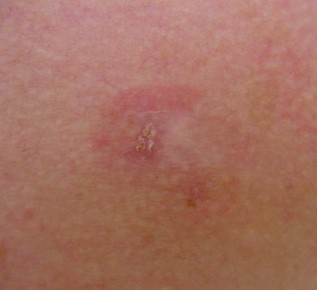 CUTANEOUS ADENOID CYSTIC CARCINOMA 