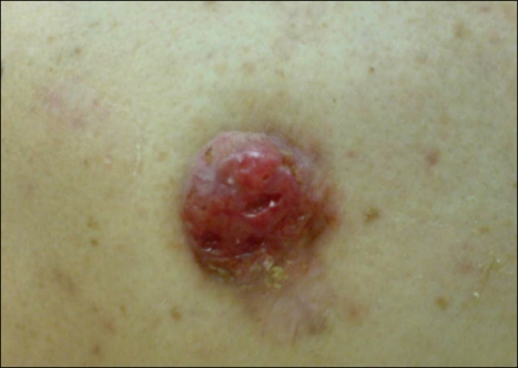 CUTANEOUS BASOSQUAMOUS CARCINOMA