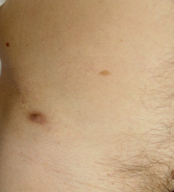 CUTENEOUS EXTRASKELETAL OSTEOSARCOMA