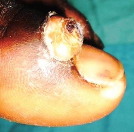 CUTANEOUS HORN