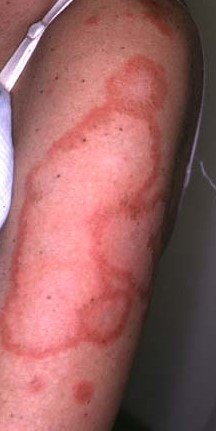 CUTANEOUS LUPUS ERYTHEMATOSUS